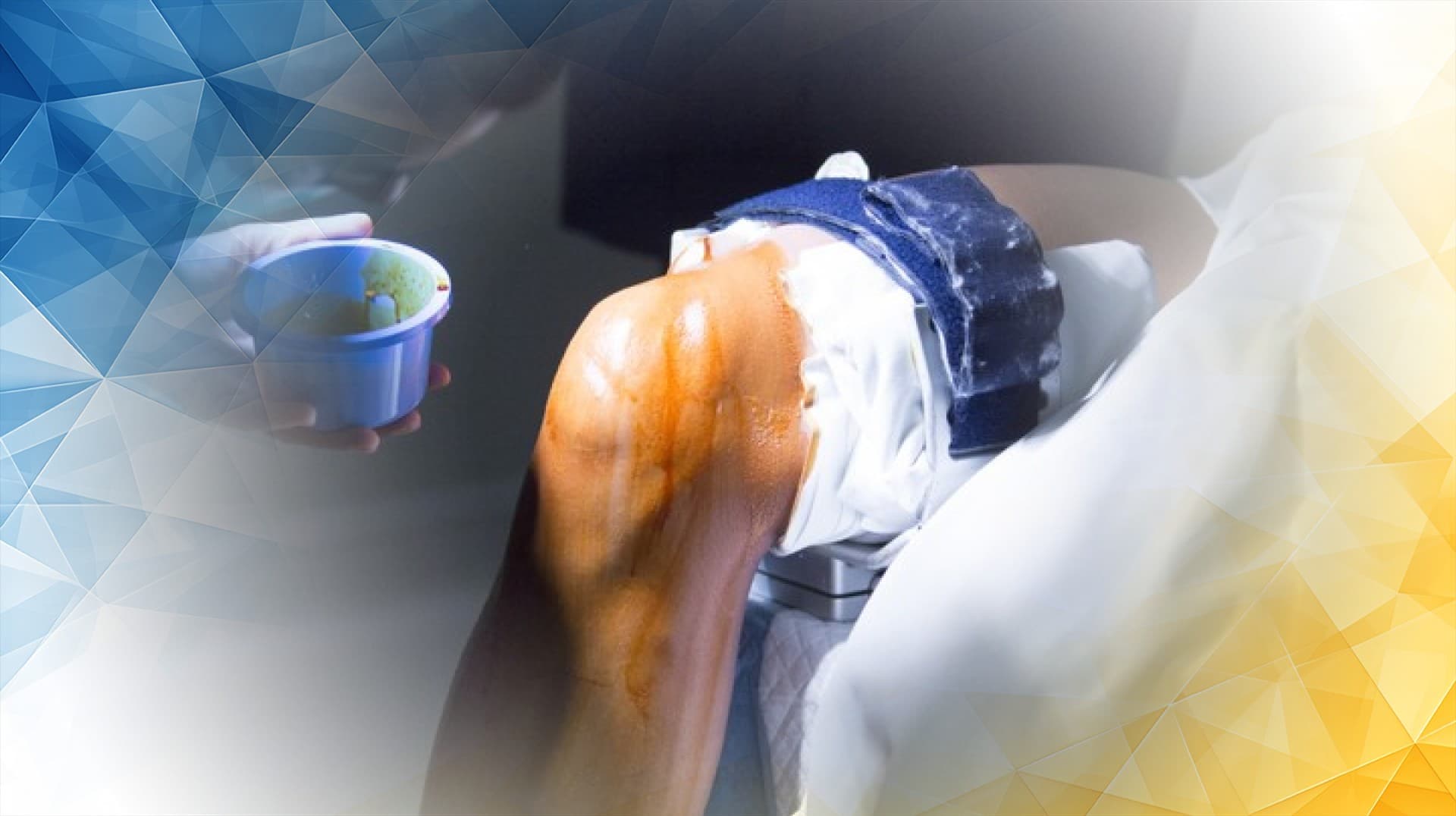 Knee Cartilage Replacement Surgery Procedures Recovery and NHS Access