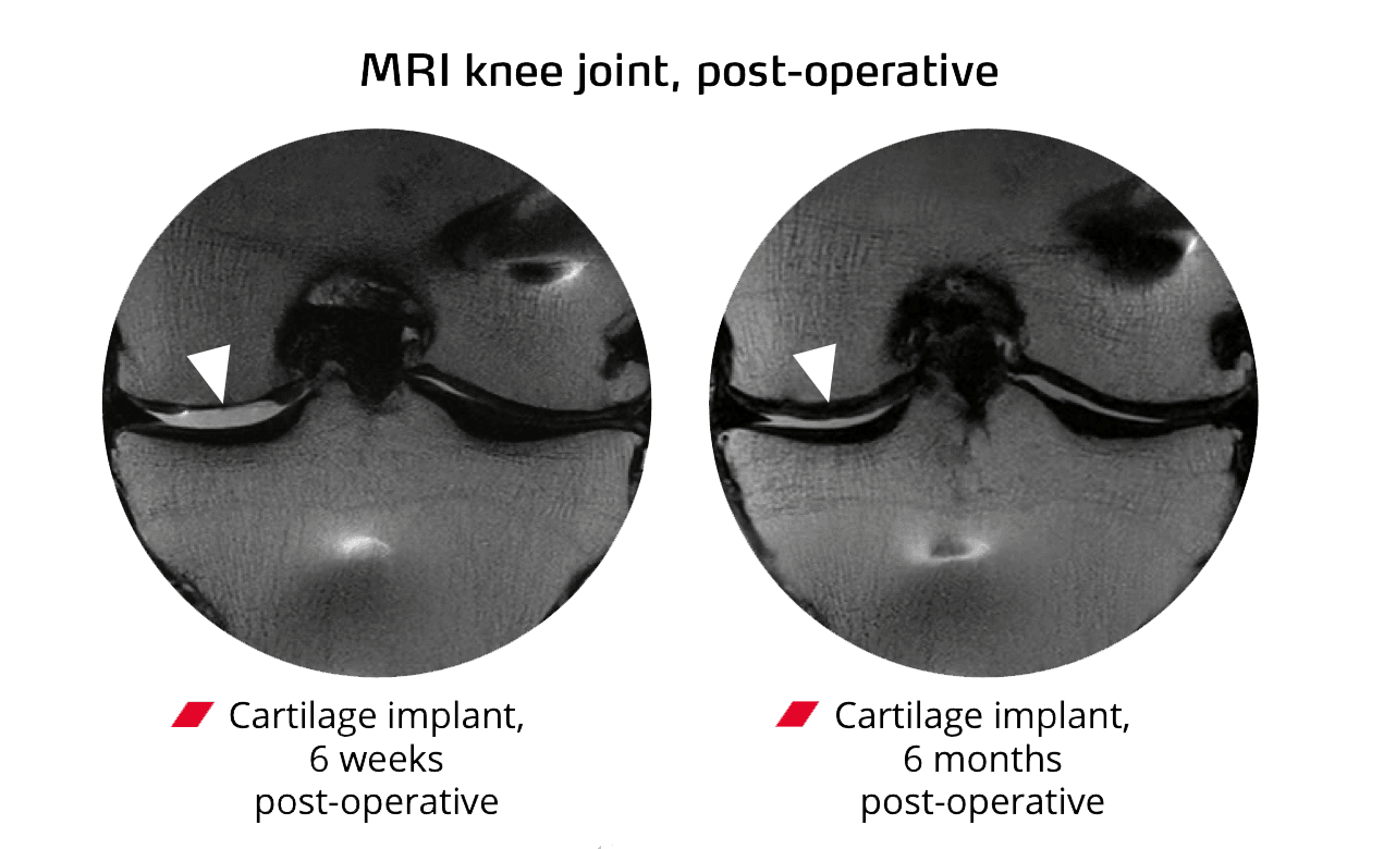 ChondroFiller treatment illustration 2